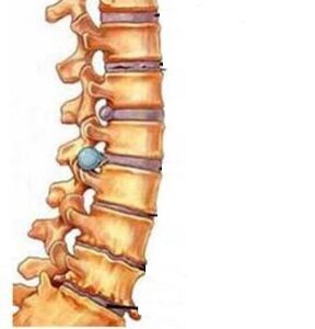 Como se desenvolve a osteocondrose da rexión cervical