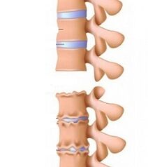 Etapas de ramplas de osteocondrose do pescozo