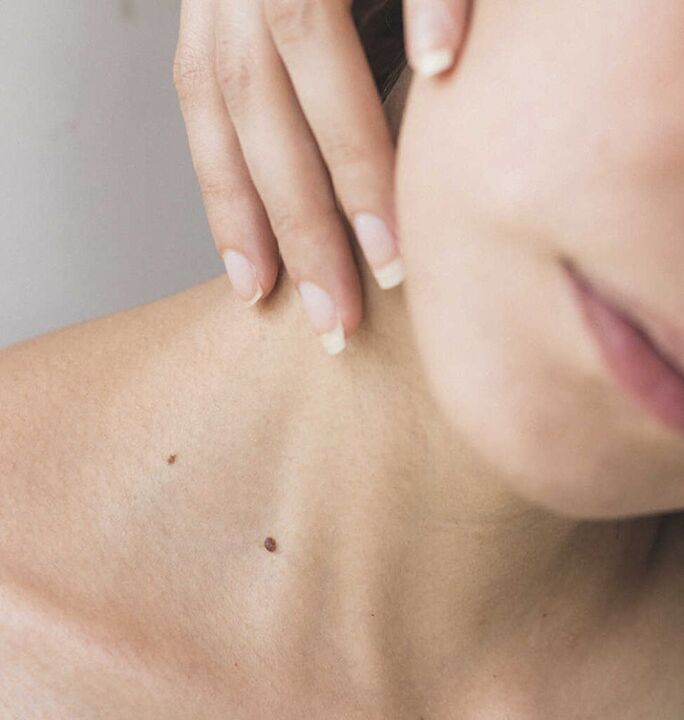 A rixidez no pescozo é un dos síntomas da fase inicial da osteocondrose da columna cervical