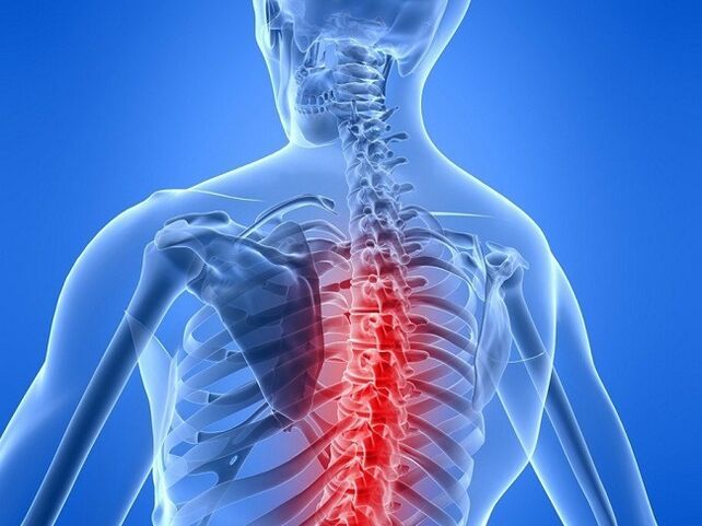 osteocondrose da columna vertebral torácica