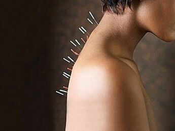A reflexoterapia é un método eficaz para tratar a osteocondrose cervical