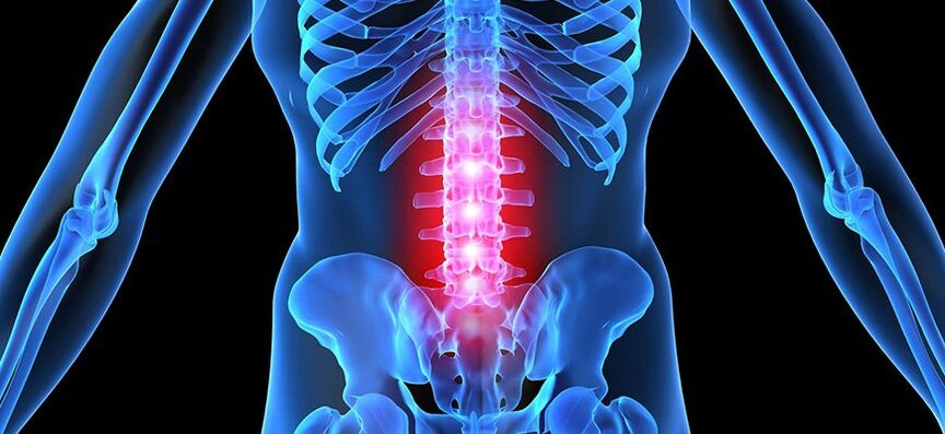 características da osteocondrose lumbar